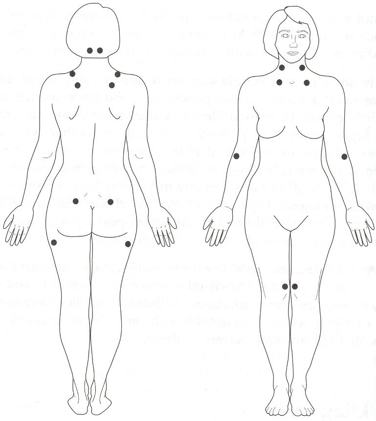 Front and back views of a nude woman showing FMS tender points